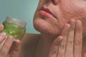 Paano mapupuksa ang mga acne scars