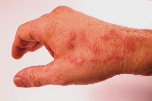 Paano mapupuksa ang urticaria