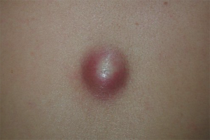 Paano mapupuksa ang atheroma