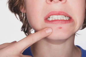 Paano mapupuksa ang subcutaneous acne sa baba