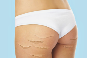 Paano mapupuksa ang mga stretch mark sa mga binti