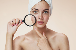 Paano alisin ang pamumula ng acne