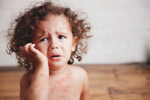 Paano gamutin ang urticaria sa mga bata