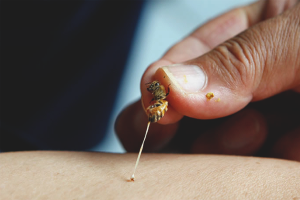 Paano mapawi ang pamamaga pagkatapos ng isang wasp sting