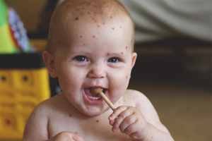 Ang bulutong-bugas sa mga bata