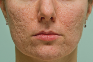 Paano matanggal ang mga scars ng acne sa iyong mukha