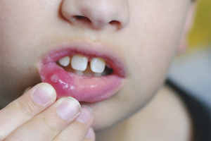 Paano gamutin ang stomatitis sa isang bata
