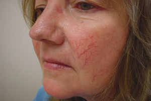 Paano gamutin ang rosacea sa mukha