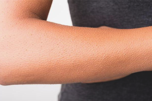 Paano mapupuksa ang mga goosebumps sa iyong mga kamay