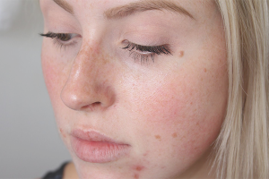 Paano matanggal ang mga marka ng acne sa iyong mukha