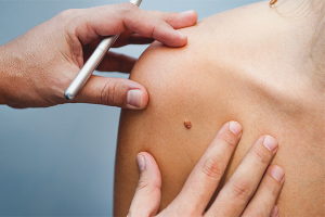 Paano mapupuksa ang mga moles