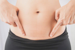 Paano hawakan ang isang suture pagkatapos ng seksyon ng cesarean