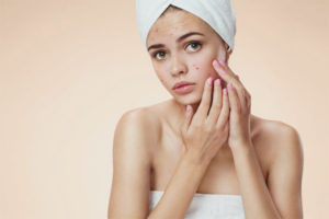 Mga hormonal acne sa mga kababaihan