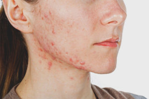 Ang acne sa mga cheekbones ng mga kababaihan