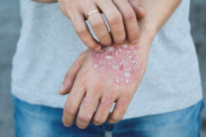 Paano gamutin ang psoriasis