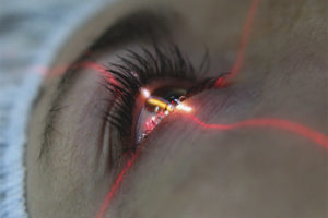 Pagwawasto ng Laser