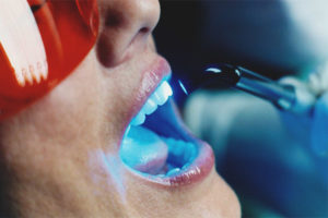 Laser ngipin pagpaputi